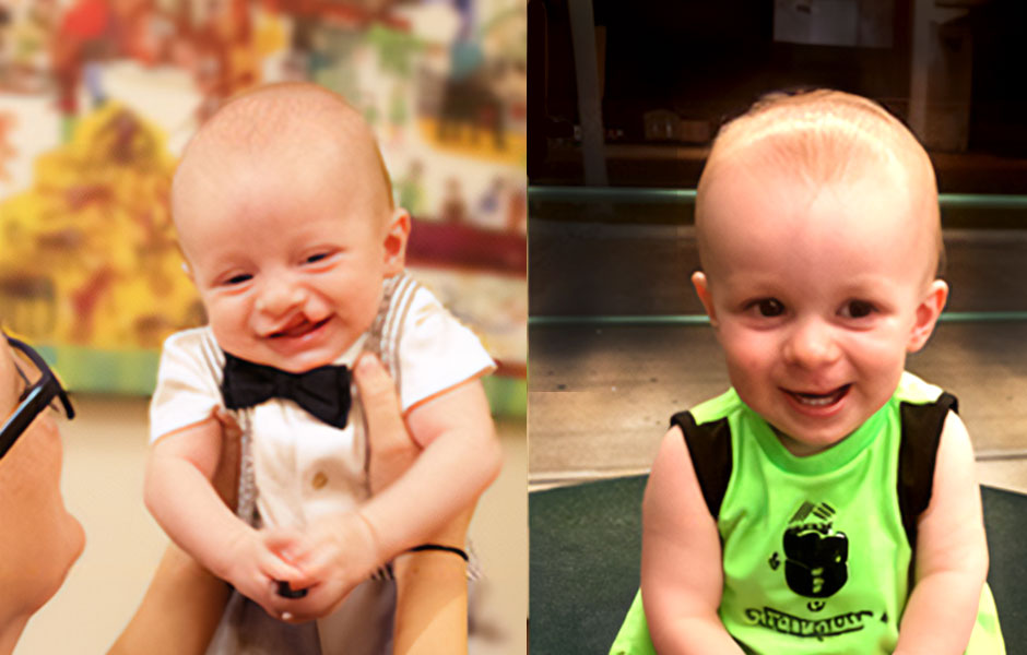 Plastic Surgery patient boy before and after cleft palate surgery.